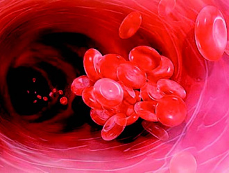 Риск венозной  тромбоэмболии  у пациентов  с подагрой