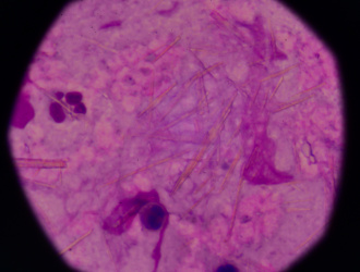 Увеличение дозы аллопуринола  с целью снижения уровня мочевой  кислоты в сыворотке ниже 6 мг/дл: открытое дополнительное исследование