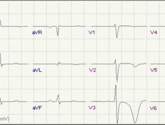 Мета-анализ эффективности  аллопуринола в отношении  снижения частоты развития  инфаркта миокарда  после проведения  аортокоронарного шунтирования