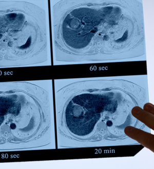 Клинический случай: необычное развитие гепатоцеллюлярной карциномы во время иммуносупрессивного лечения ревматоидного артрита с сопутствующим синдромом Шегрена; цирротический стеатогепатит с воспалением печени и фиброзом скрывается за аутоиммунными нарушениями