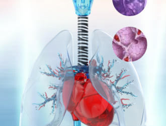 13 апреля — Всемирный день распространения информации о саркоидозе